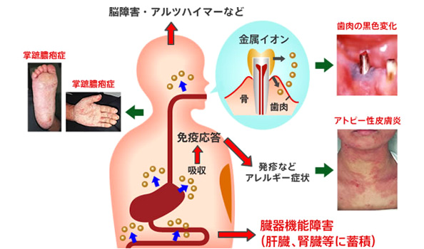 金属アレルギー
