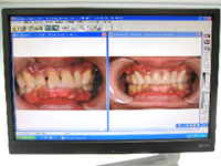 歯周病検査の流れ　口腔内写真撮影