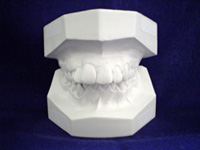 歯周病検査の流れ　口腔内模型印象
