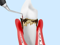 歯周病検査の流れ　歯周病ポケット検査