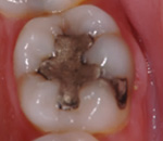 毒性歯科金属のサンプル