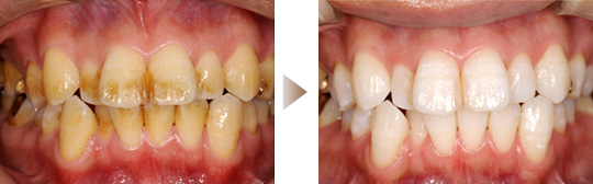 ホワイトニング