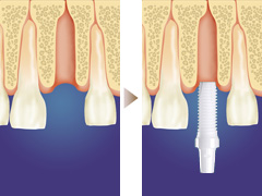 抜歯即時埋入法