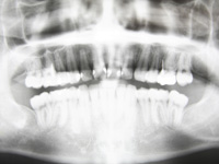 歯周病検査の流れ　口腔内全体X線写真