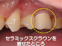 インプラント治療の流れ