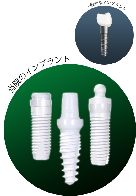 一般的なインプラント・当院のインプラント