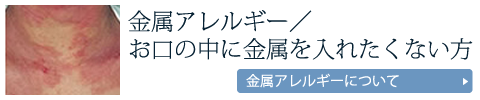 金属アレルギー／お口の中に金属を入れたくない方