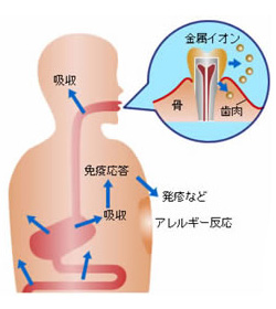 毒性歯科金属は身体に悪影響を及ぼす可能性があります