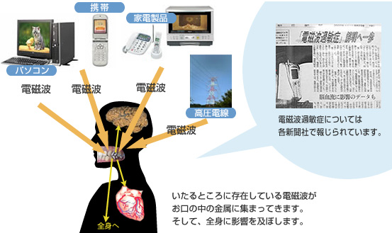 歯科金属は電流発生だけでなく、アンテナとなって周りの電磁波を集めてしまう