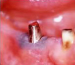 毒性歯科金属のサンプル