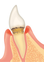軽度歯周病