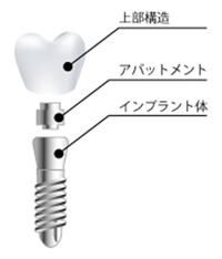 インプラントの構造